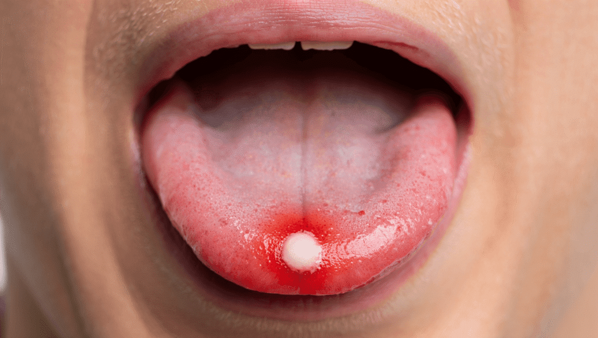 Bouton sur la langue : est-ce grave ?