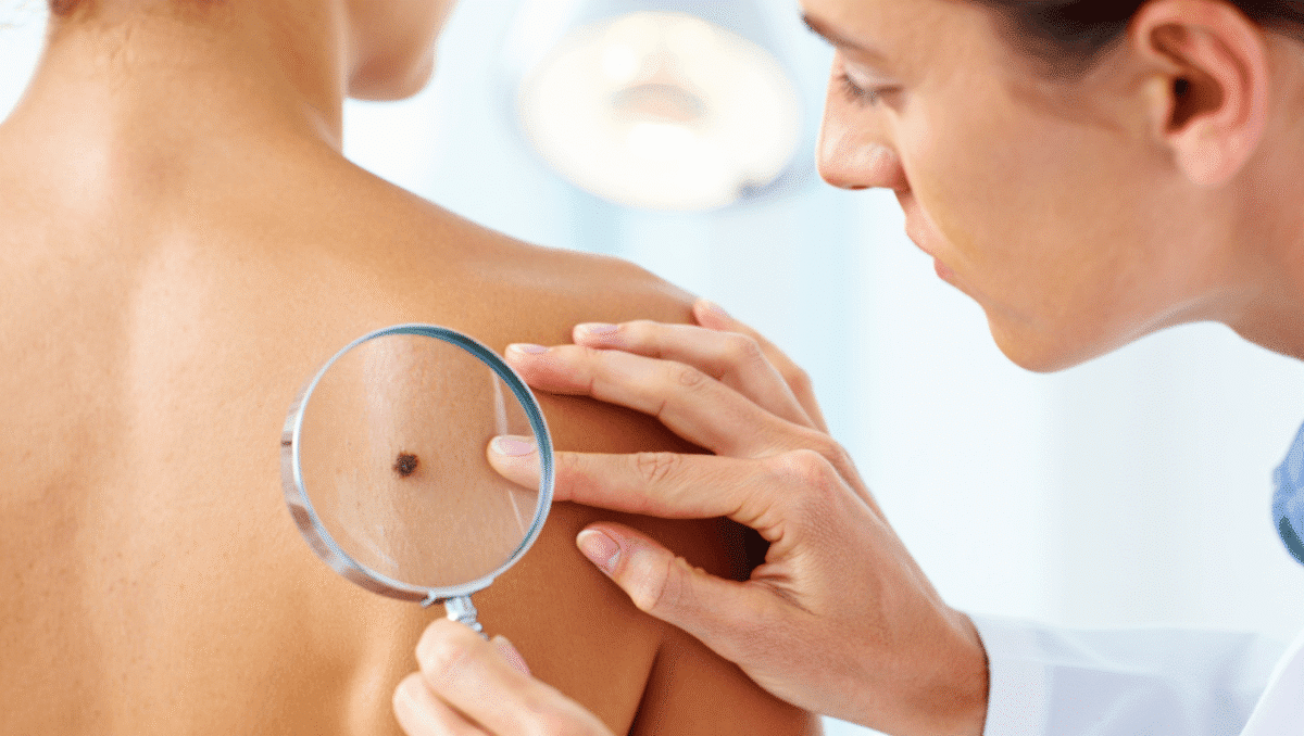 Le premier signe du cancer de la peau tient en un mot, alerte un
dermatologue