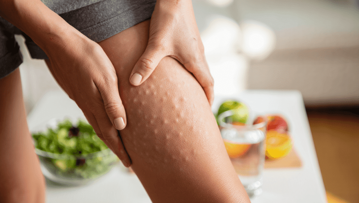 4 erreurs alimentaires qui aggravent la cellulite