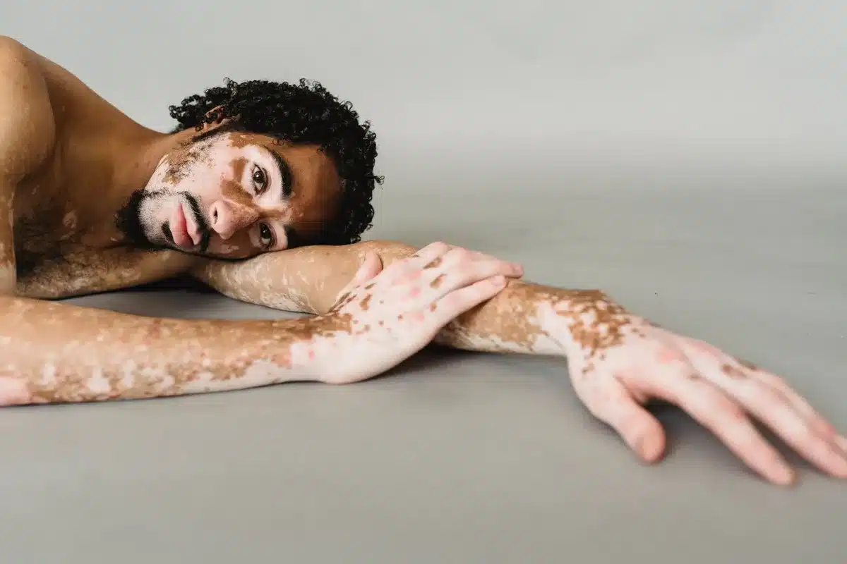 Peau marqu&eacute;e par les effets du soleil avec taches pigmentaires visibles