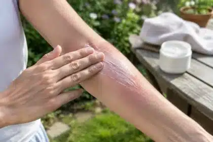 Comment apaiser un coup de soleil et protéger sa peau ?