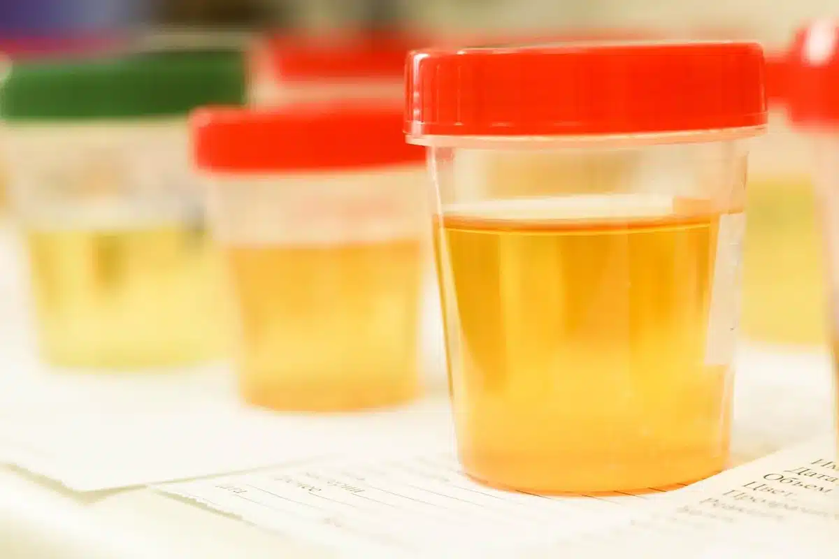 Tube de prélèvement et formulaire de bilan lipidique ready for analysis